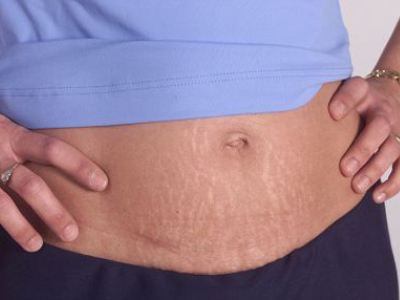 strijų ant rankų po svorio metimo saugus svorio metimas krūtimi maitinančioms motinoms